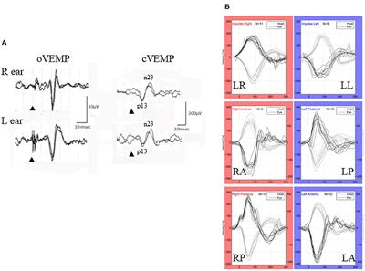 Isolated Otolith Dysfunction in Persistent Postural-Perceptual Dizziness